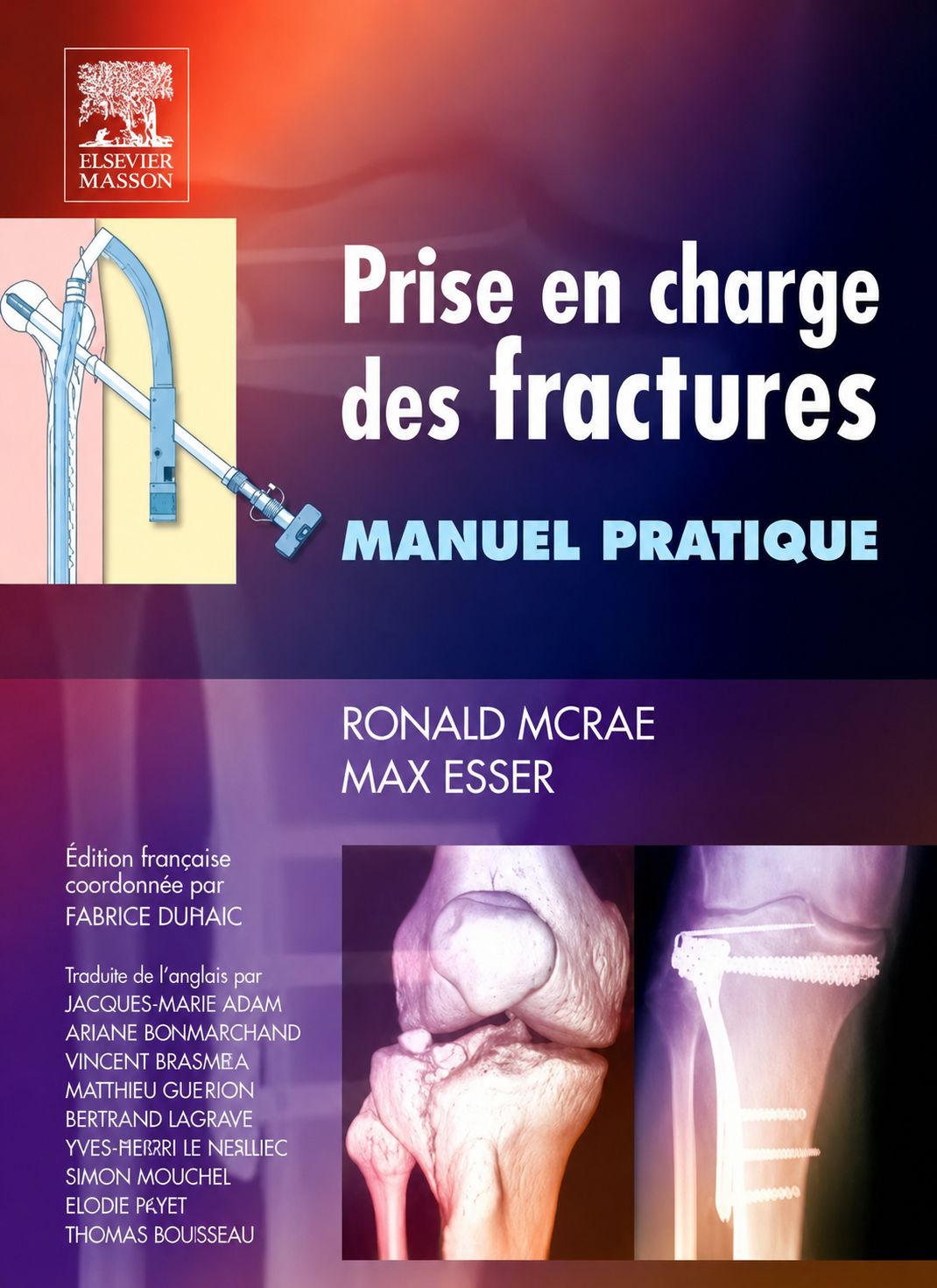 Prise en charge des fractures